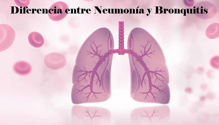Diferencia entre Neumonía y Bronquitis