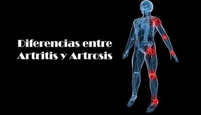 Diferencias entre Artritis y Artrosis